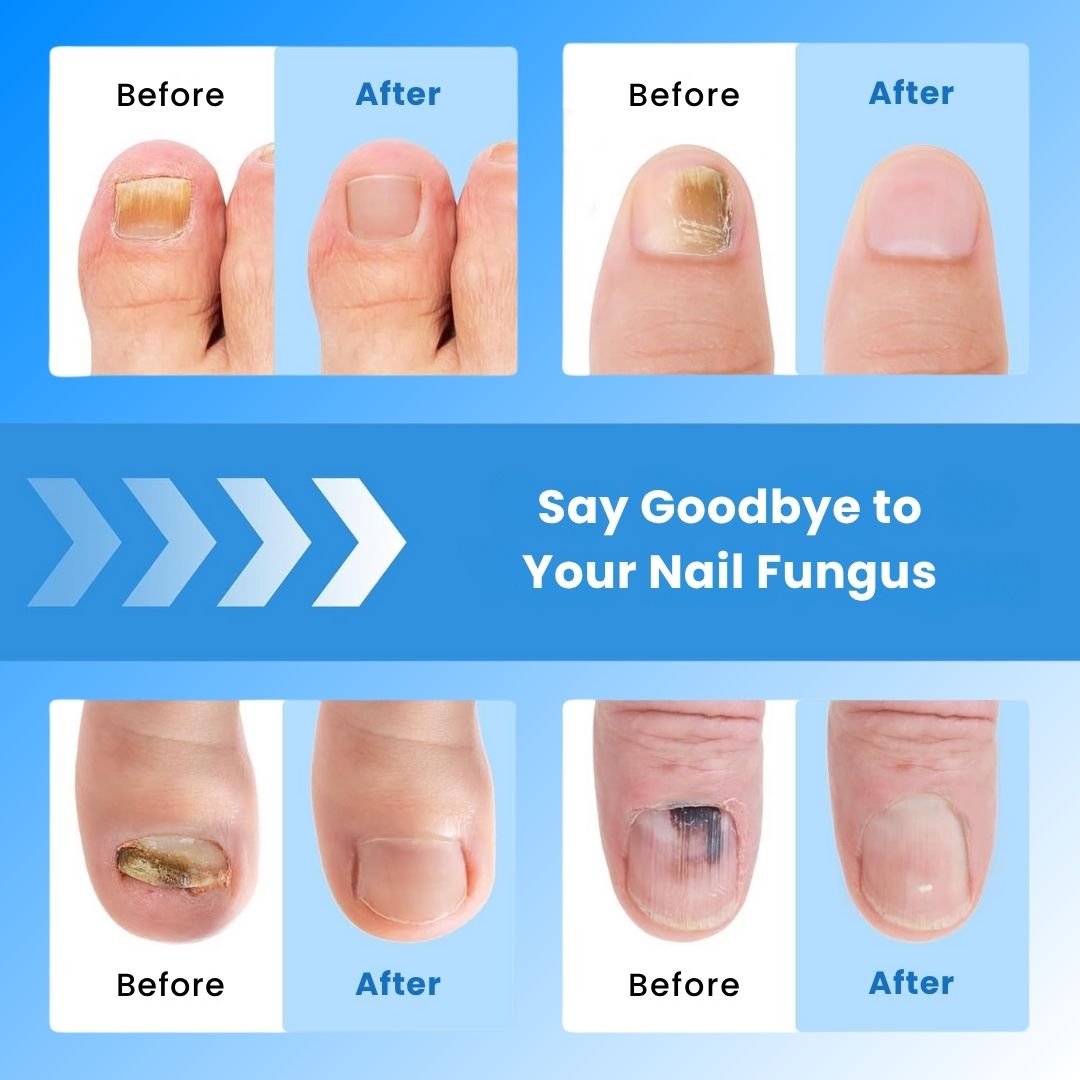 NailCure Pro™ - Laser Nail Treatment Device