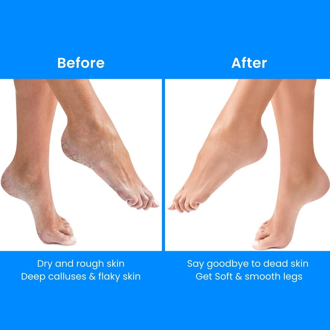CallusCut™ - Electric Foot Callus Remover