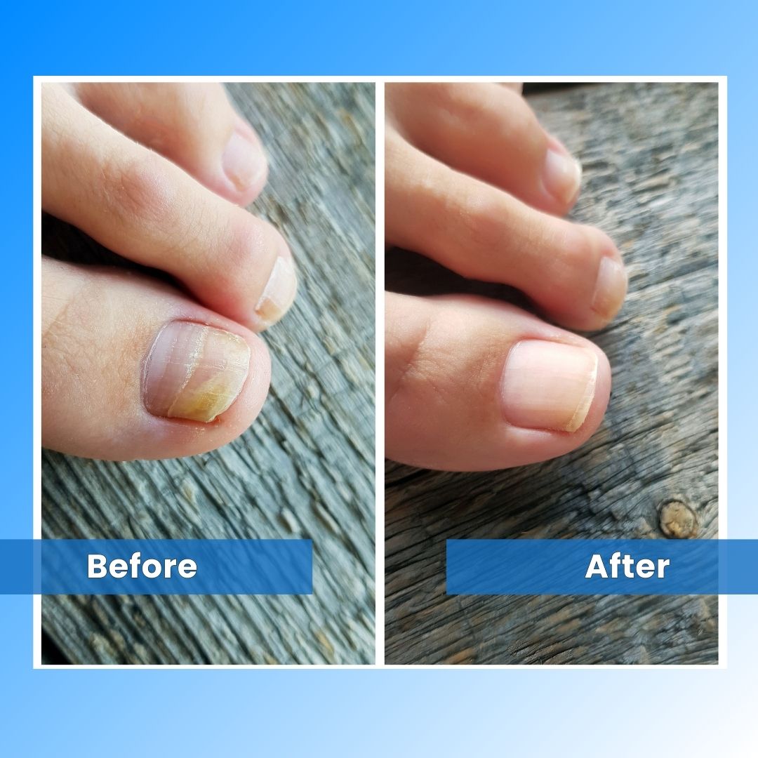 Nail Fungus Treatment Tools Fungal Nail Treatment Device Anti-Equipment Effectively Remove Fungal Toenail Nail Fungal Infection