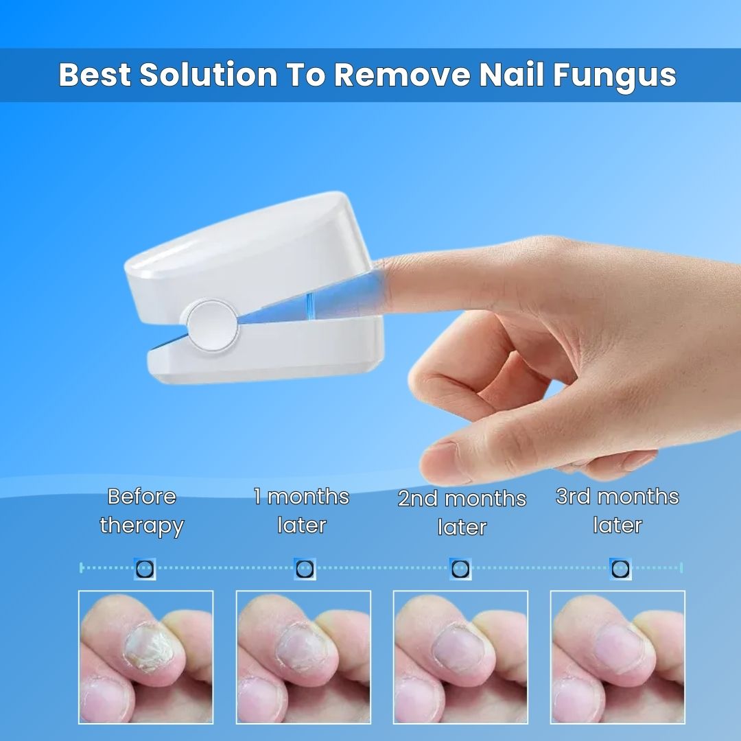 Nail Fungus Treatment Tools Fungal Nail Treatment Device Anti-Equipment Effectively Remove Fungal Toenail Nail Fungal Infection