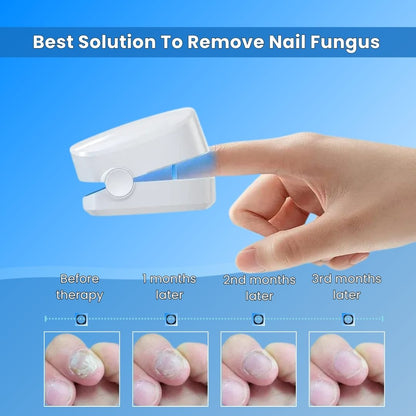 Nail Fungus Treatment Tools Fungal Nail Treatment Device Anti-Equipment Effectively Remove Fungal Toenail Nail Fungal Infection