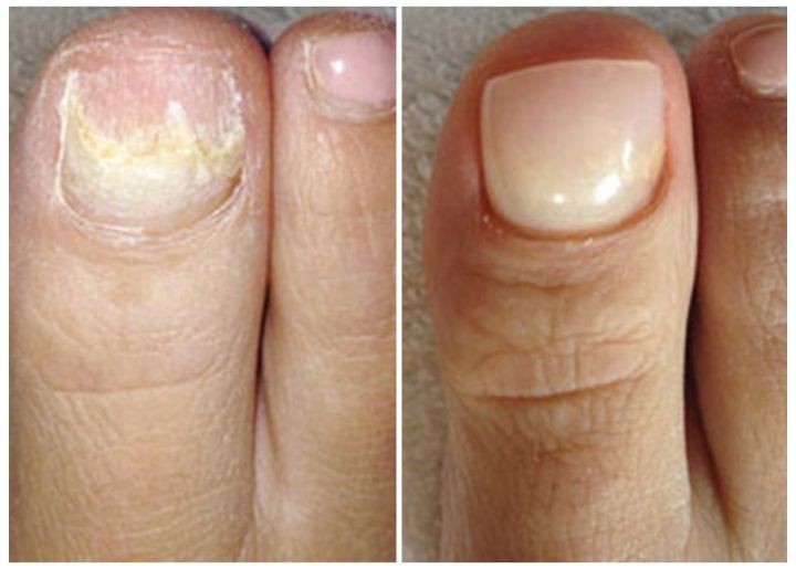 nail fungus laser device test-3